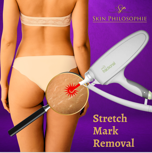 Stretch Mark Removal (1 session)